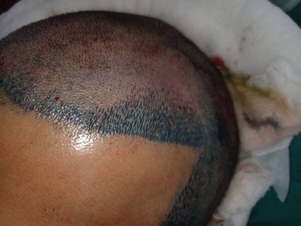 hairtransplantbangladesg