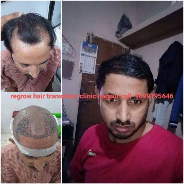 hairtransformation baldness