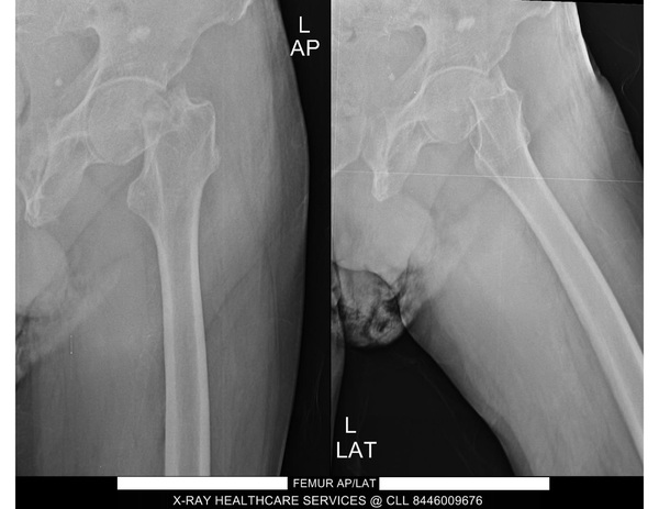 portable post opp x ray femur 