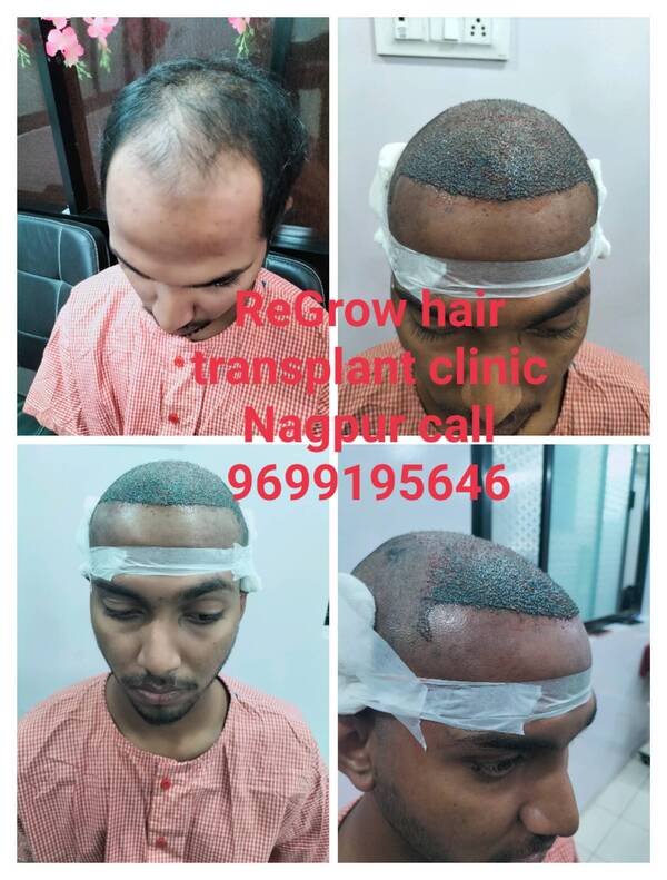 Call regrow hair transplant 96