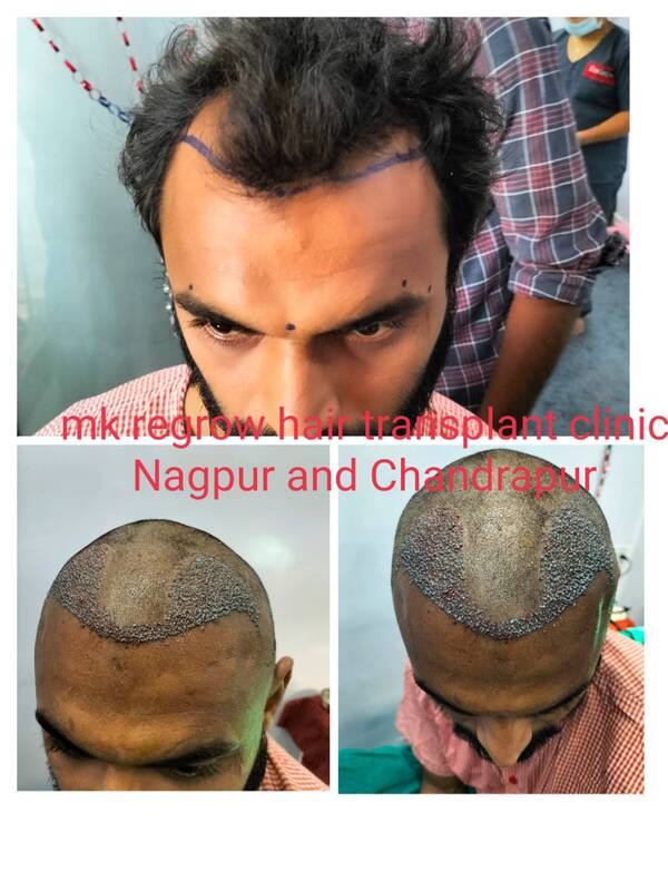 nagpur hair transplant clinic
