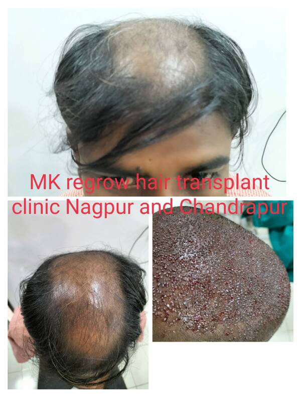 hairreplacement