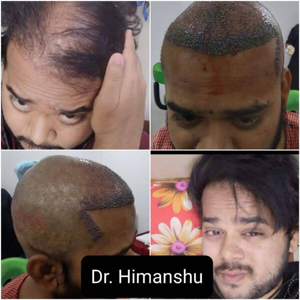 hair grafting surgery