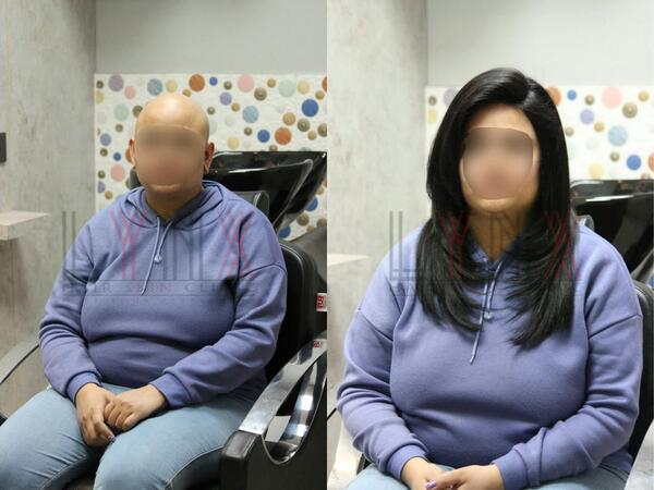 Wigs for Cancer patients in Bangalore-

