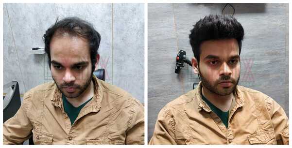 Hair Fixing in Jaipur-

The hair on an i