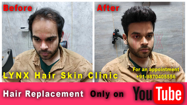 Hair Bonding in  Jaipur-

Hair loss, par