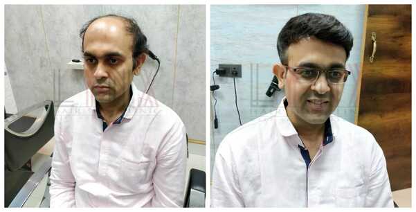 Hair Fixing in Hyderabad-

The hair on a