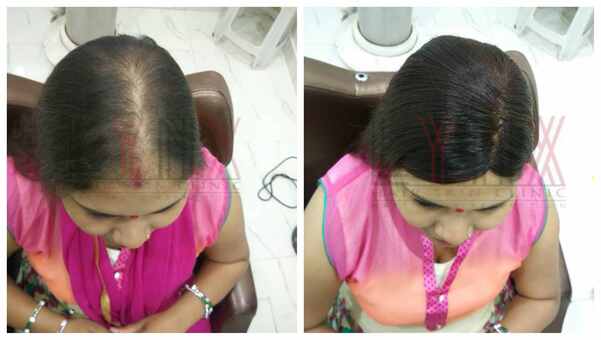 Choosing the best Hair Replacement in Ba