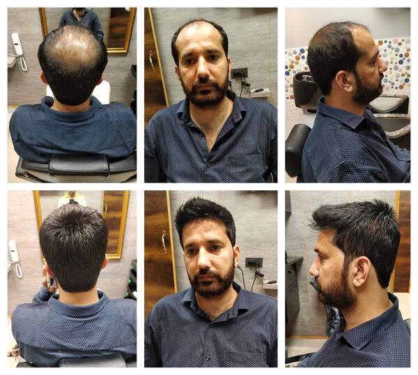 Hair Replacement in Hyderabad-

Hair los