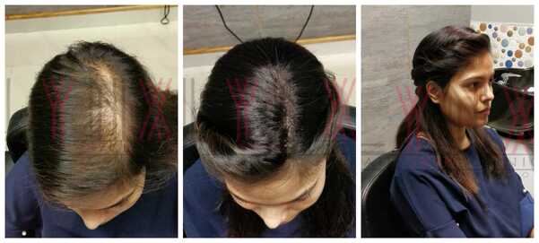 Benefits of Hair Replacement in Hyderaba