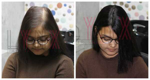 Choosing the best Hair Replacement in Ja