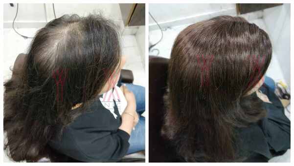 Hair Replacement in Kolkata-

Hair loss 