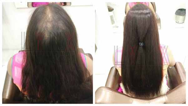 Choosing the best Hair Replacement in Ko