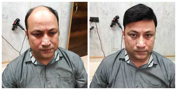 Benefits of Hair Fixing in Wadala Mumbai