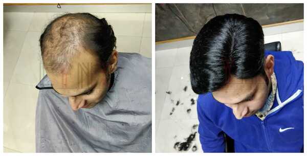 Choosing the best Hair Replacement in Co