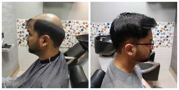 Hair Replacement in Wadala Mumbai-

Hair