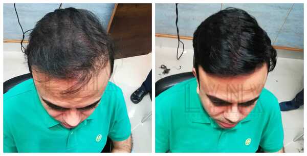 Advantages of Hair Weaving in Secunderab