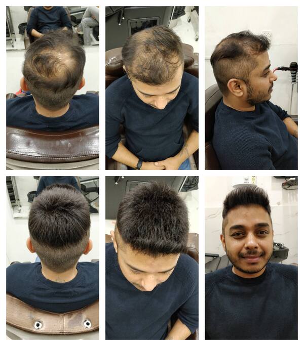 Hair Patch in Bangalore- 

Going bald ca