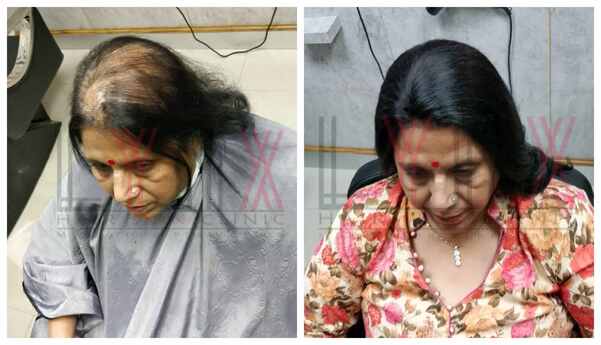 Benefits of Hair Fixing in Bangalore-
1)