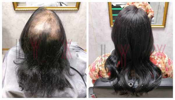 Hair Bonding in Bangalore-

Hair loss, p