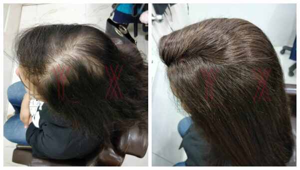 Benefits of Hair Bonding-

Doctors also 
