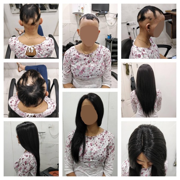 Wigs for Cancer patients in Bangalore-

