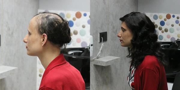 Chemo wigs procedure in Bangalore-

Our 