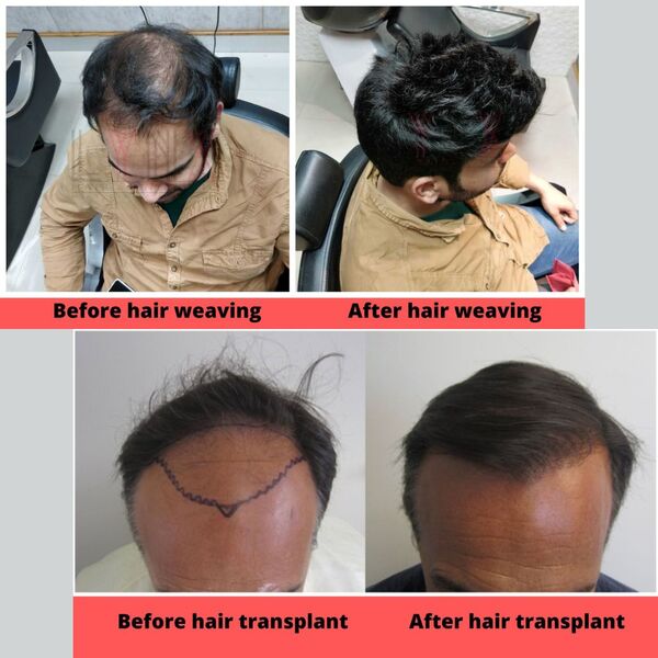 Hair patch or Replacement or Weaving Vs 