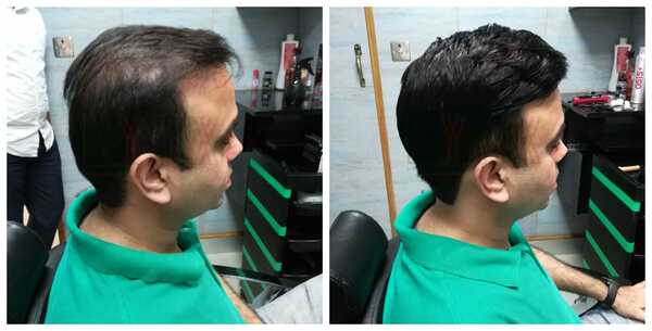 Hair Replacement in Bangalore-

Hair los