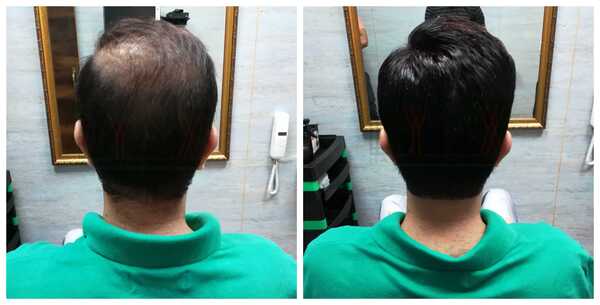 Choosing the best Hair Replacement in Ba