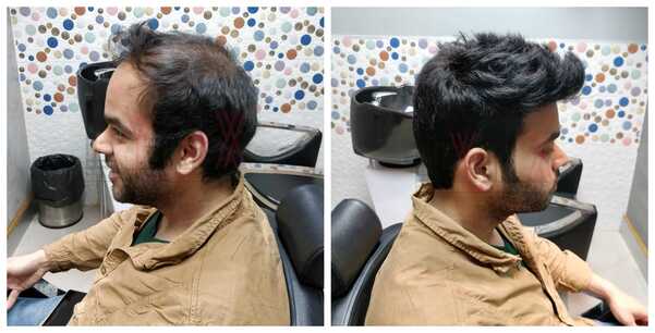 Benefits of Hair Replacement in Bangalor