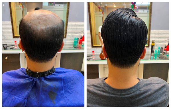 Hair Patch in North Delhi-

The Hair Pat