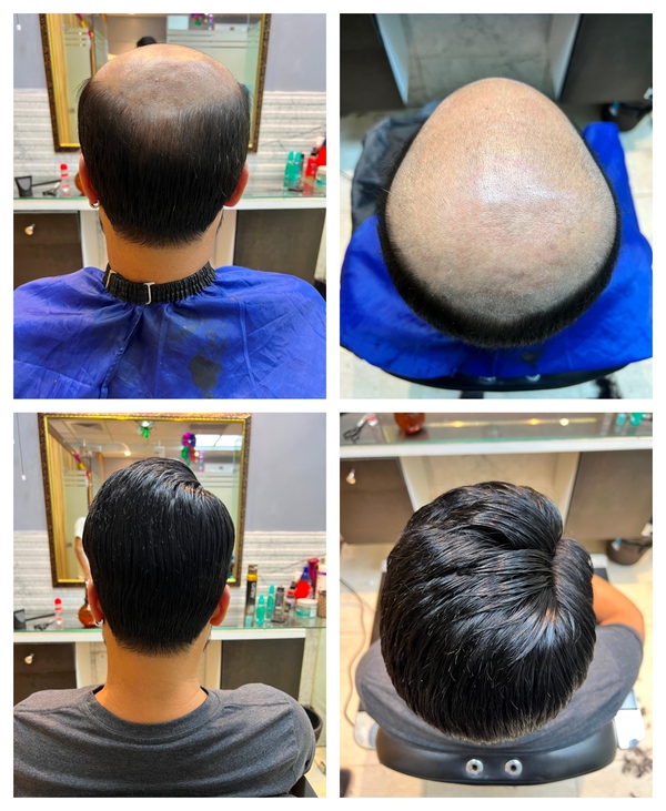 How to apply a Best hair patch in North 