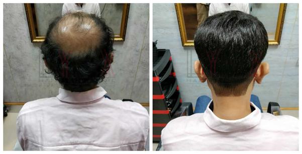 Hair Patch in Khammam-

Going bald can h