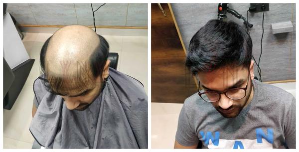 Hair wigs in Warangal-
There are so plen