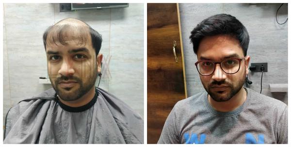 Hair Patch in Whitefield-

Going bald ca
