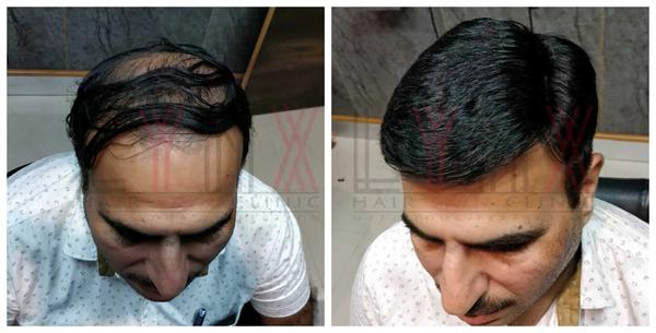 Hair Patch in Indiranagar-

Going bald c