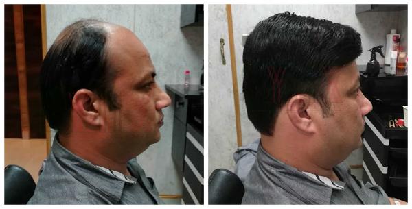 Hair Patch in Yelahanka-

Going bald can