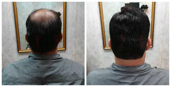 Hair Patch in Malleswaram-

Going bald c