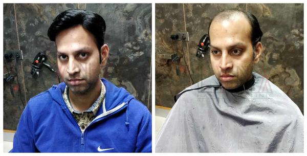 Hair Patch in Jayanagar-

Going bald can