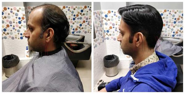 Hair Patch in Yeswanthpur-

Going bald c