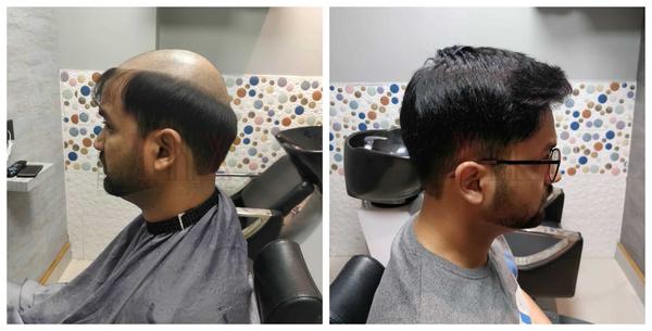 Hair Patch in Vadodara-

Going bald can 
