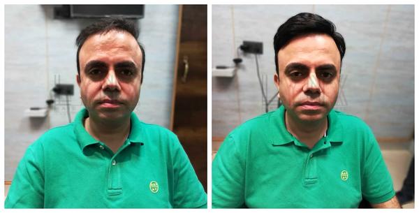 Hair Patch in Gandhinagar-

Going bald c