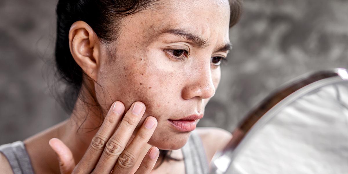            BEST MELASMA TREATMENT IN GHA