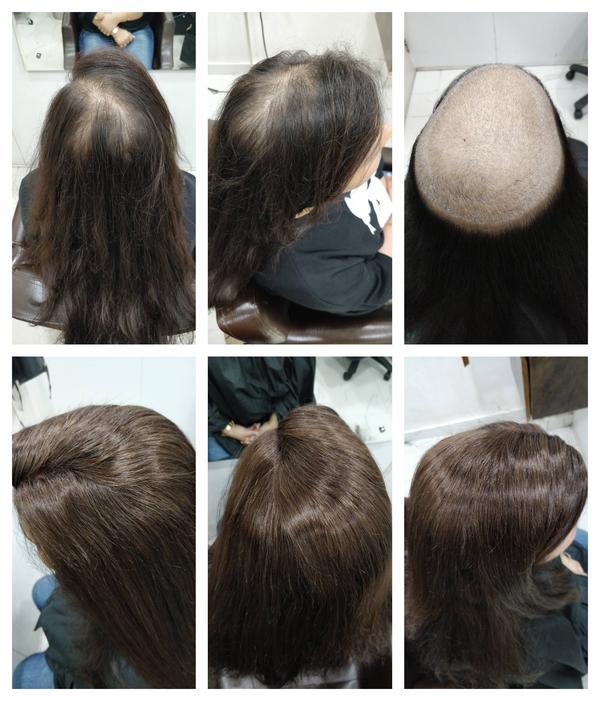 Hair Fixing Treatment in Hyderabad: Proc