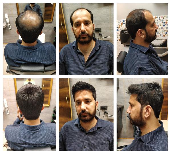 Hair Fixing in Hyderabad-

The hair on a
