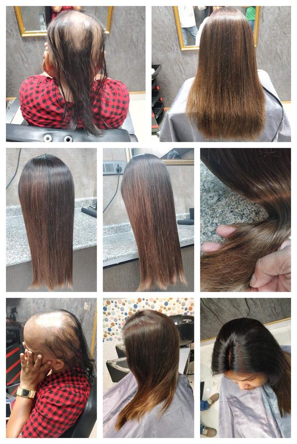 Best Hair Fixing in New Delhi-

Hair los