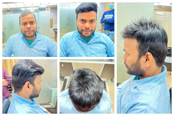 Hair Patch in Malegaon-

Going bald can 