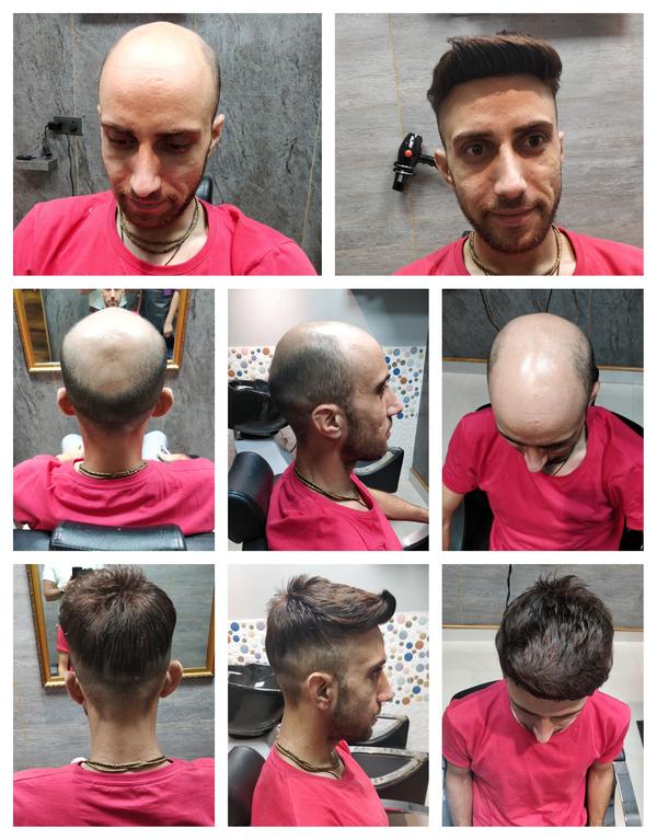 Hair Patch in Aurangabad-

Going bald ca