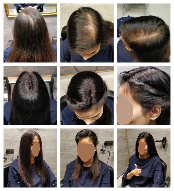 Hair Patch in Shimla-

Going bald can ha